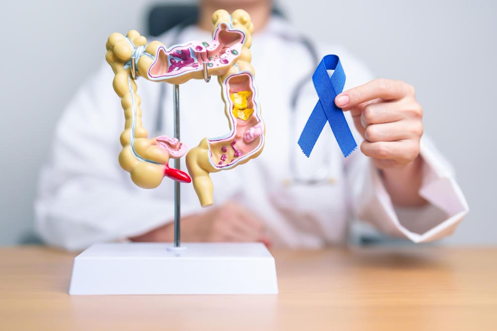 Cáncer de colon y recto en CDMX: Diagnóstico oportuno y tratamiento especializado