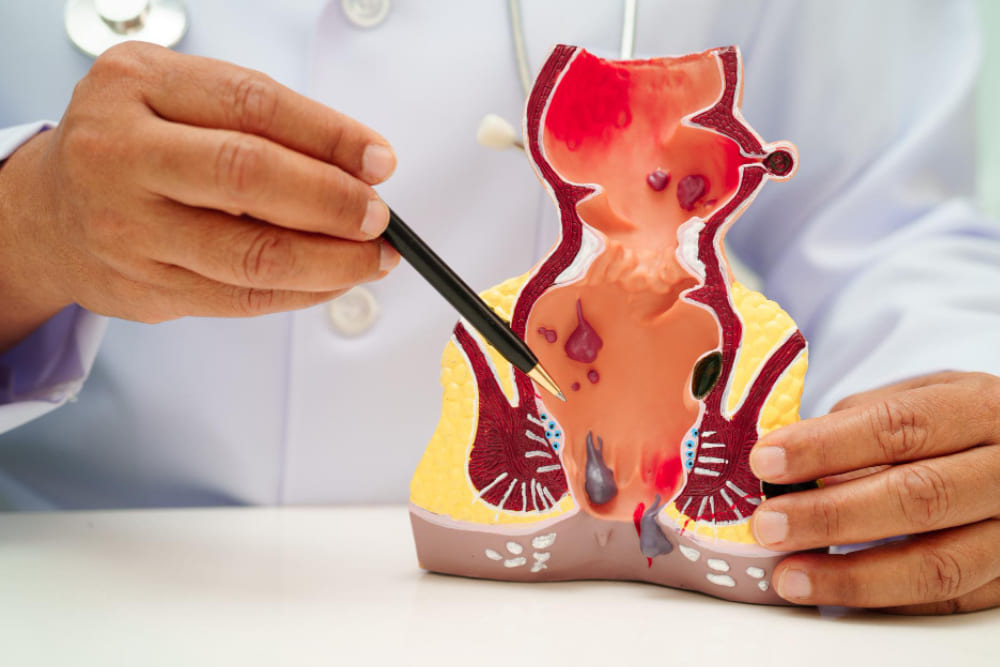 Cirugía de hemorroides