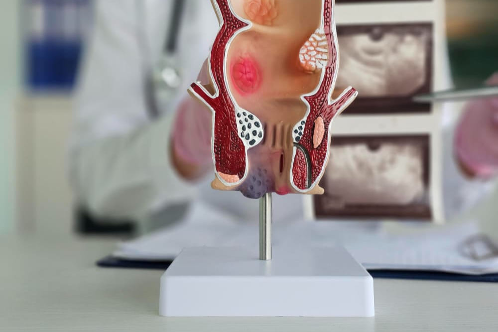 Tratamiento de fisura anal